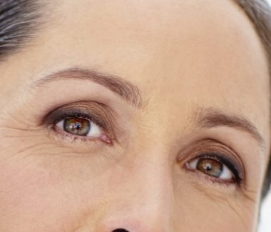 Upper Eyelid Lift