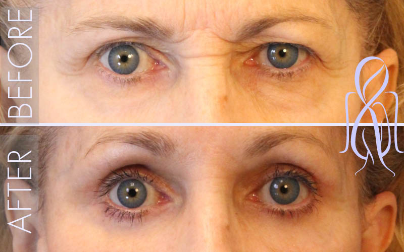 Lower Eyelid Lift Blepharoplasty (Eyelid Surgery) in Atlanta, GA