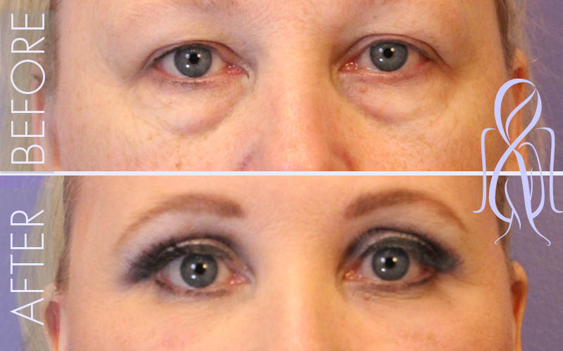 Lower Eyelid Lift Blepharoplasty (Eyelid Surgery) in Atlanta, GA