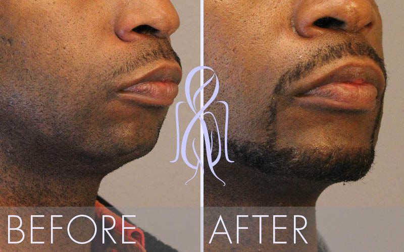 Chin Implant Surgery for Men | Atlanta Face & Body