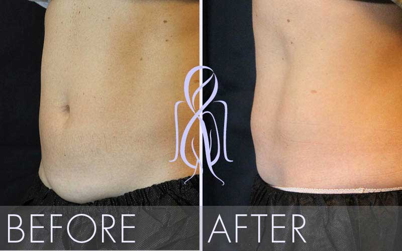 SculpSure™ NonSurgical Fat Reduction Procedure in Atlanta GA