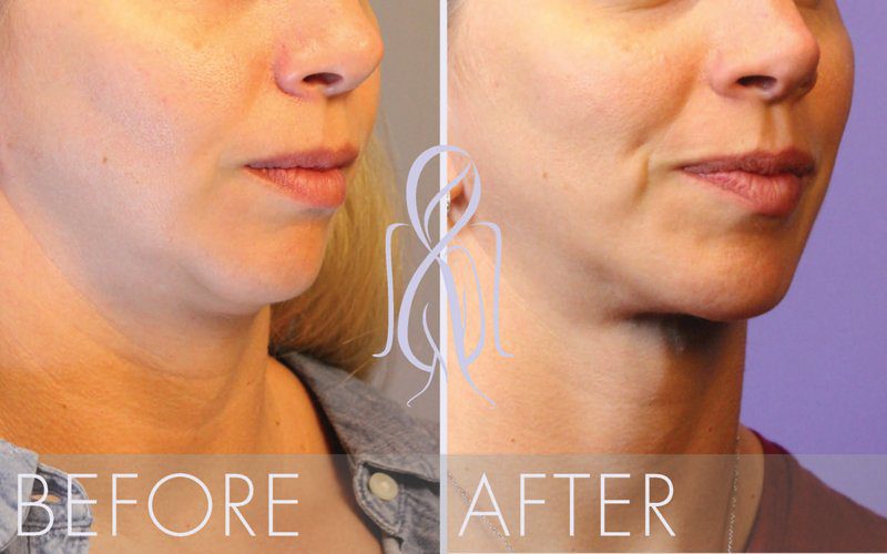 PrecisionLift™ Laser Facelift, Atlanta Less Invasive. Quicker Recovery.