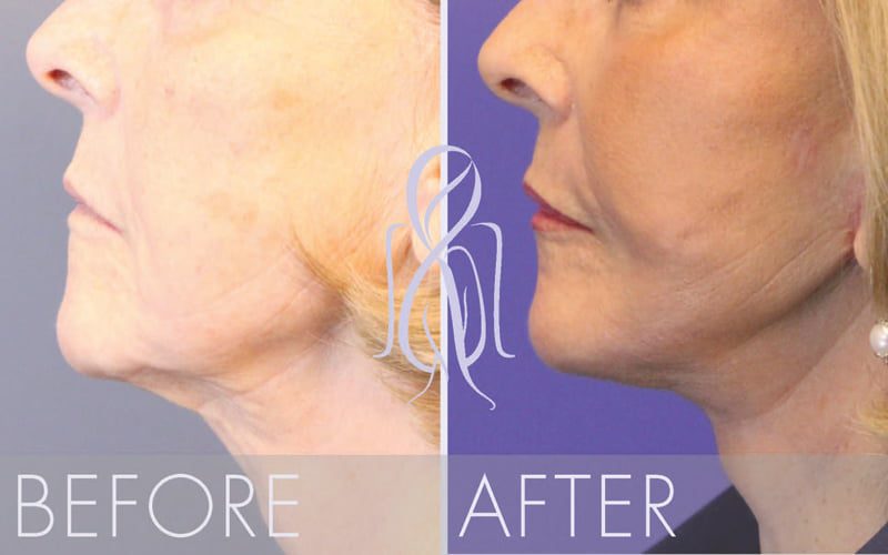 PrecisionLift™ Laser Facelift, Atlanta Less Invasive. Quicker Recovery.