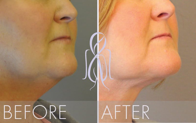 PrecisionLift™ Laser Facelift, Atlanta Less Invasive. Quicker Recovery.