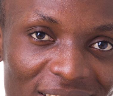 Buccal Fat Reduction for Men