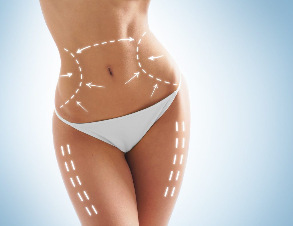 SculpSure Marks for Woman's Torso