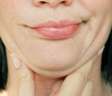 Tired of Your Chin Roll? Say Goodbye with These Double Chin Procedures