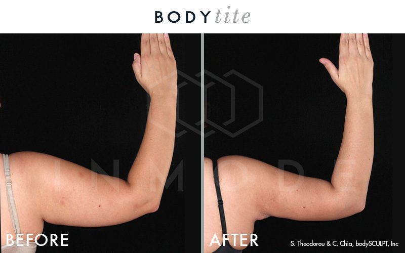 bodytite contouring invasive minimally inmode face before atlanta