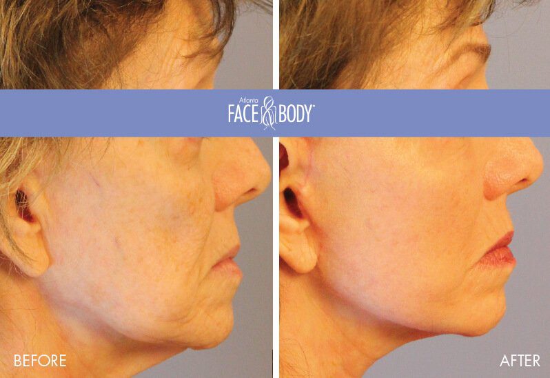 Mini Facelift in Atlanta Before & After
