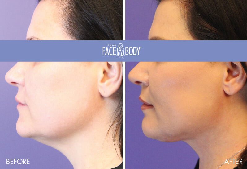 Laser Facelift in Atlanta Before & After