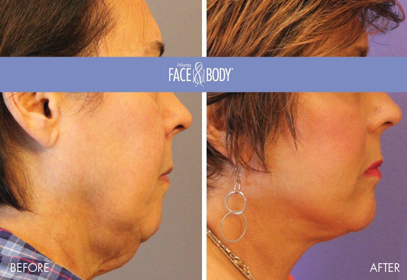 Full Facelift in Atlanta Before and After