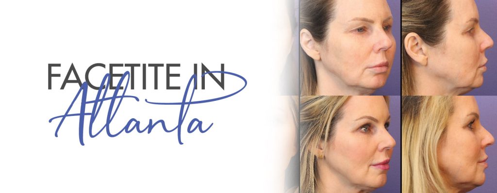 facetite in atlanta