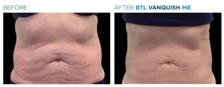 1606859165-btl-vanquish-me-bna-1