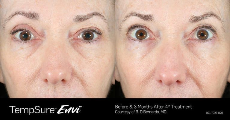 Okotokseyecare-tempsure-supportingimage