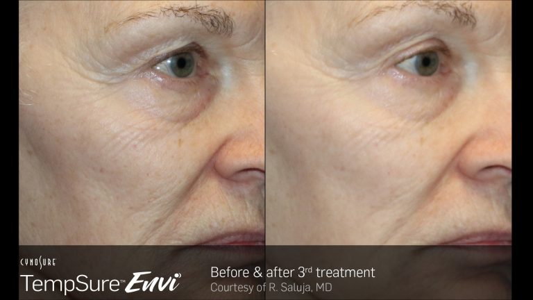 TempSure-Envi-Before-and-After-Image