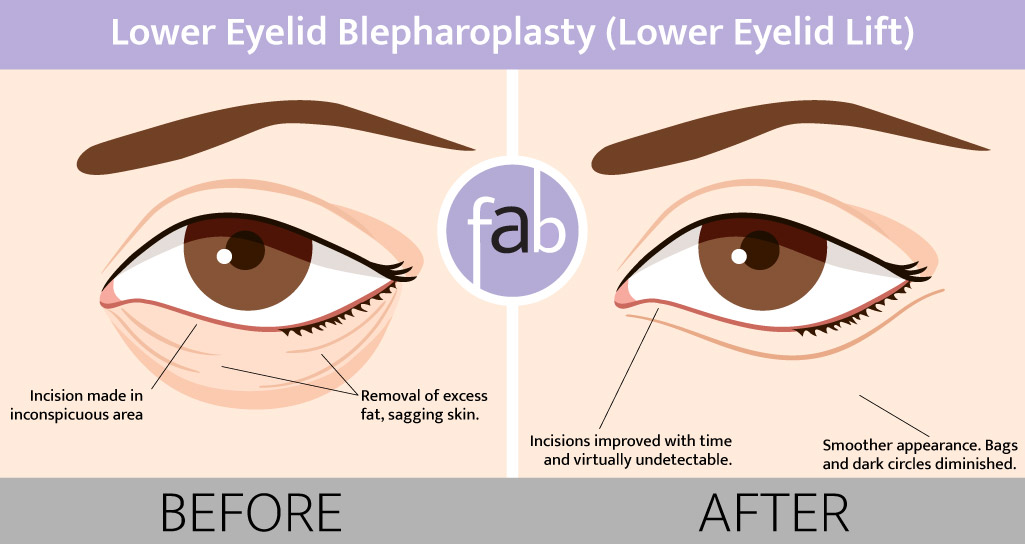 Lower Eyelid Lift Infograph