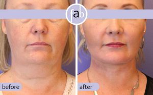 Signature facelift beauty Atlanta - front