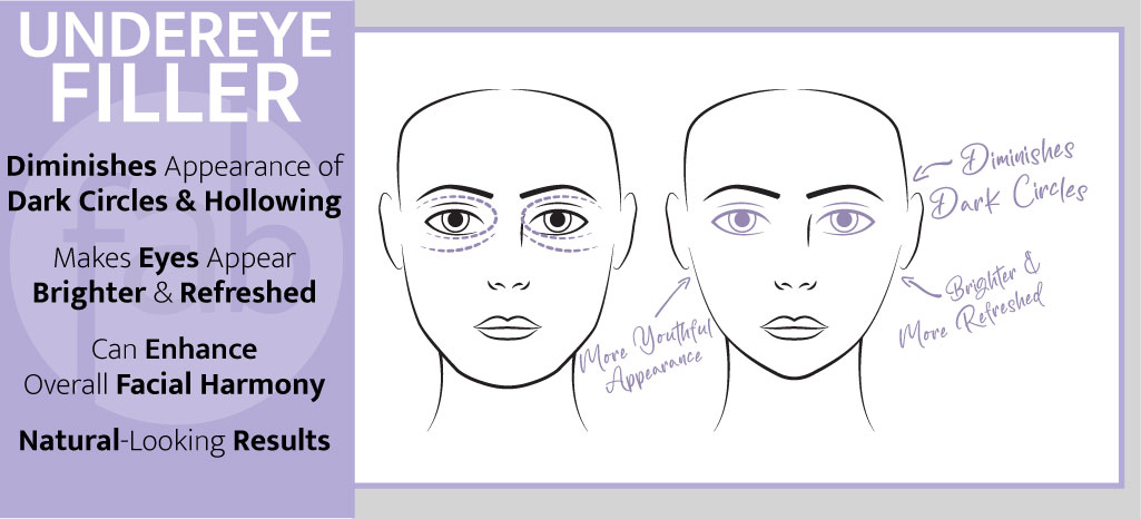 Undereye Filler Infograph
