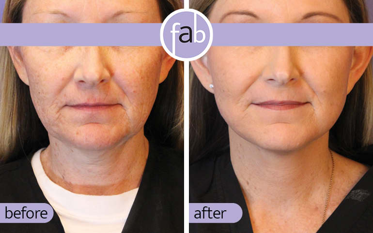 Signature MiniLift - Front