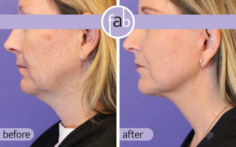 Signature MiniLift - Left