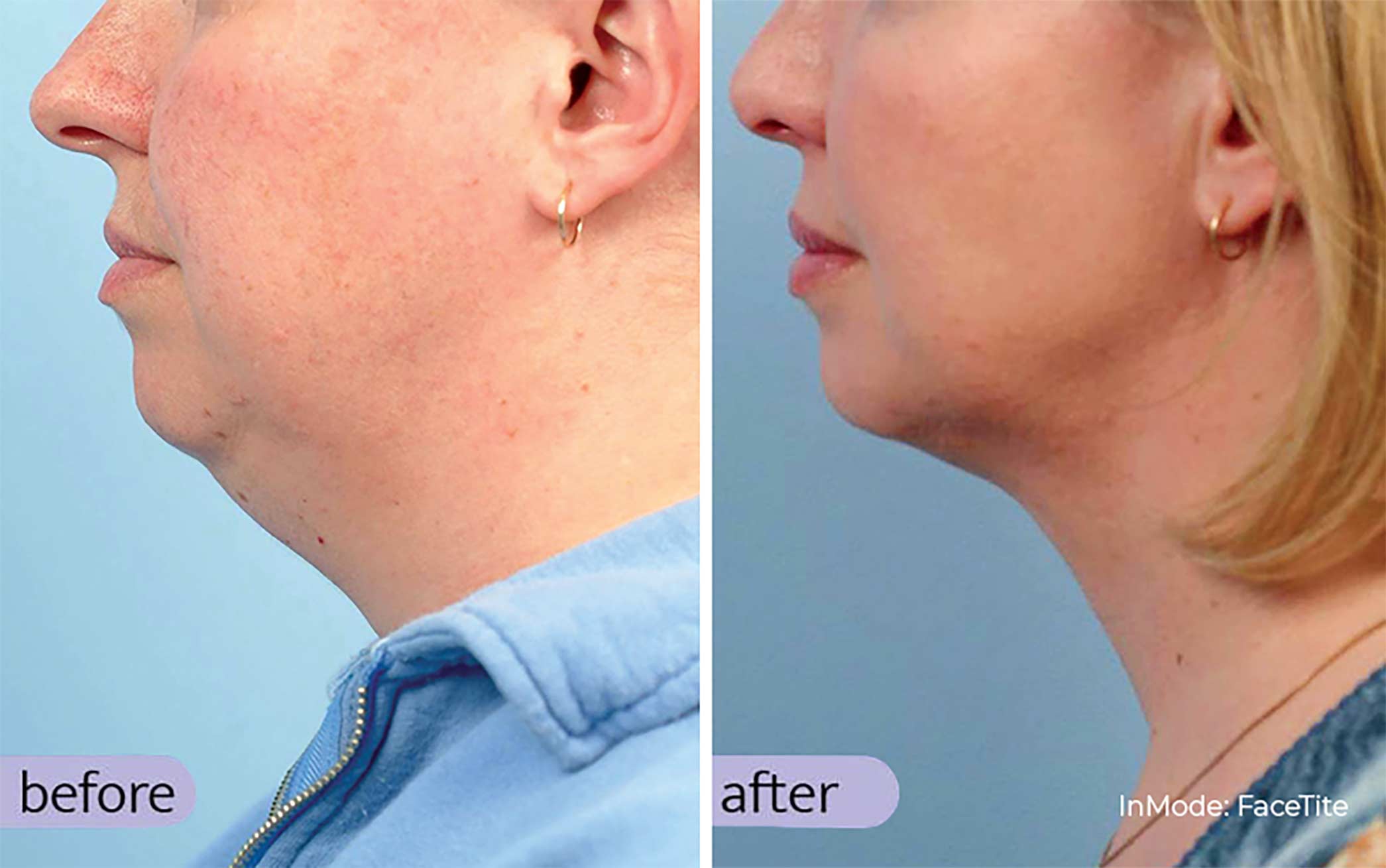 Face and Neck Skin Tightening in Atlanta