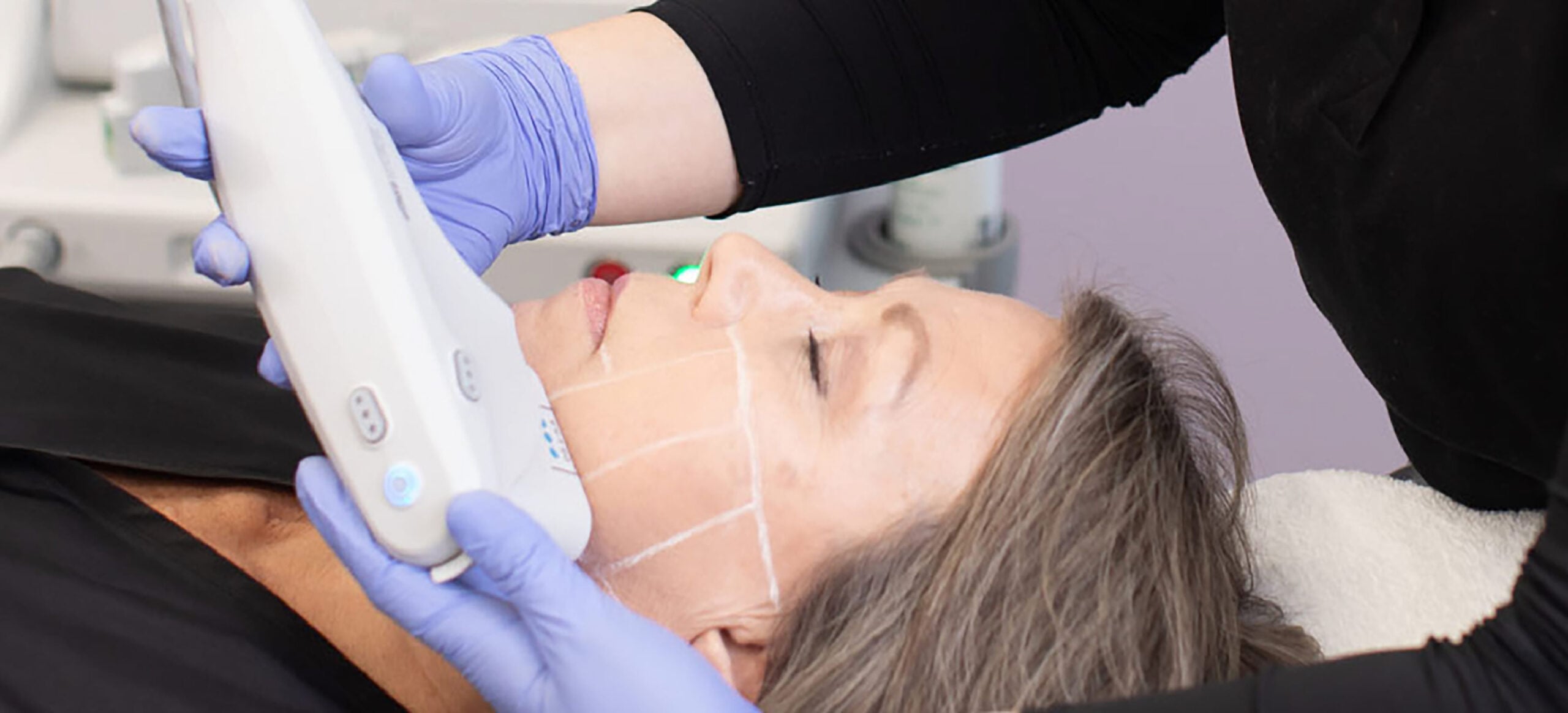 Ultherapy for treating Ozempic Face