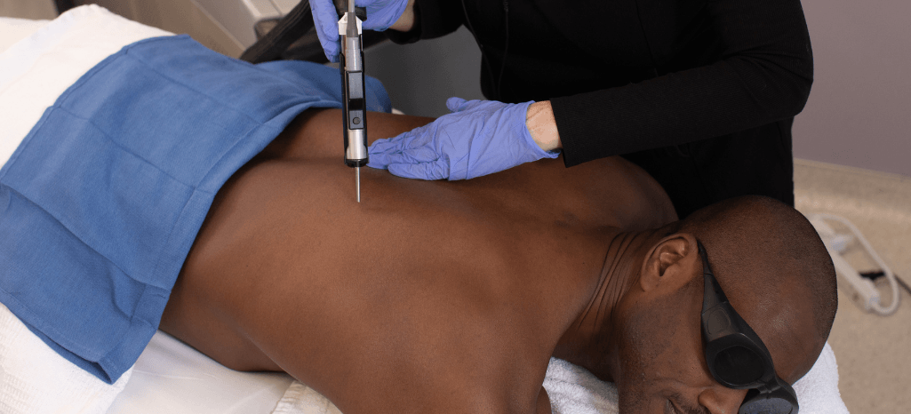 Laser Hair Removal for Men